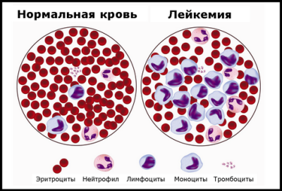 Клетки крови при лейкемии