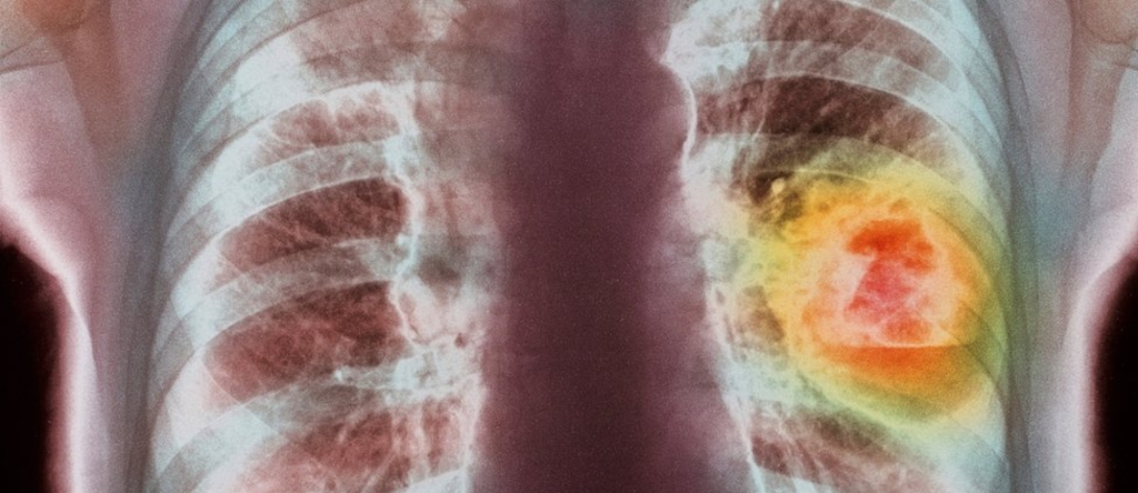 Все про Рак легких: первые симптомы и признаки, стадии, выживаемость
