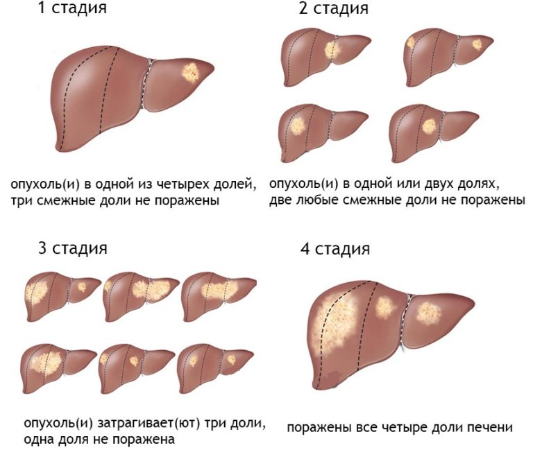 Рак кишечника фото больных