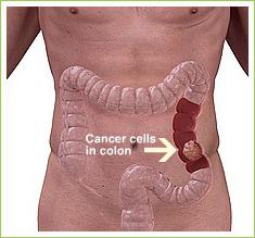 Всё про рак кишечника: первые симптомы, диагностика, стадии, выживаемость