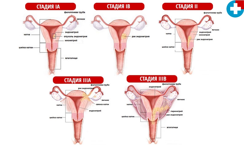 Рак матки: первые признаки и симптомы, диагностика, лечение, выживаемость