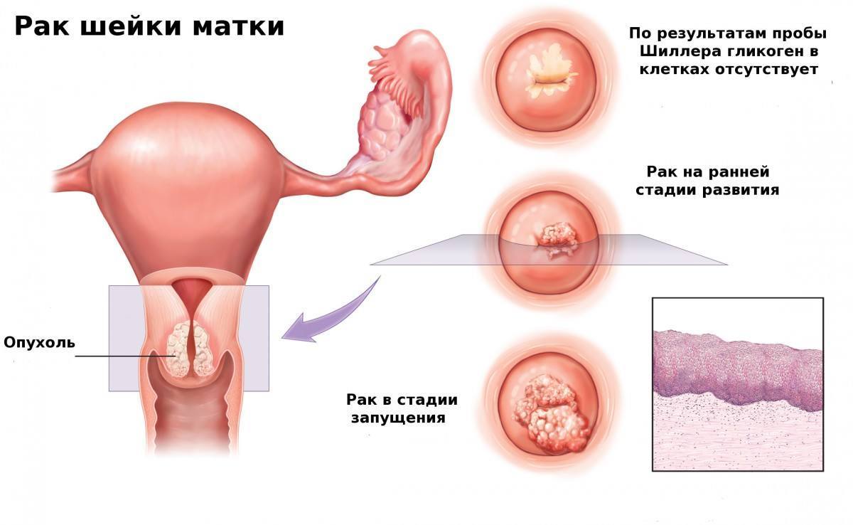 Виды рака шейки матки: плоскоклеточный