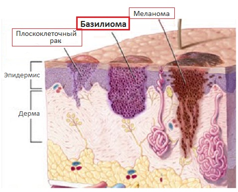 Еще одно опухолевое образование кожи - базалиома