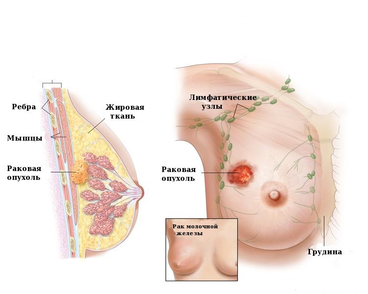 Рассмотрим 2 стадию рака груди…