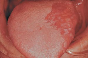 Раковые заболевания полости рта, на что следует обратить внимание