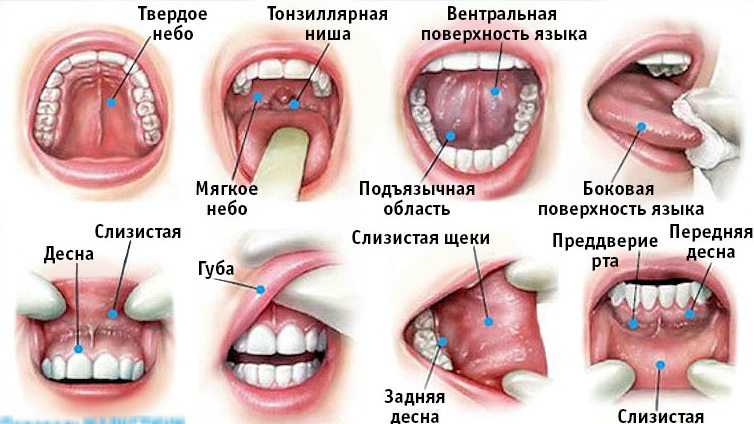 Раковые заболевания полости рта, на что следует обратить внимание