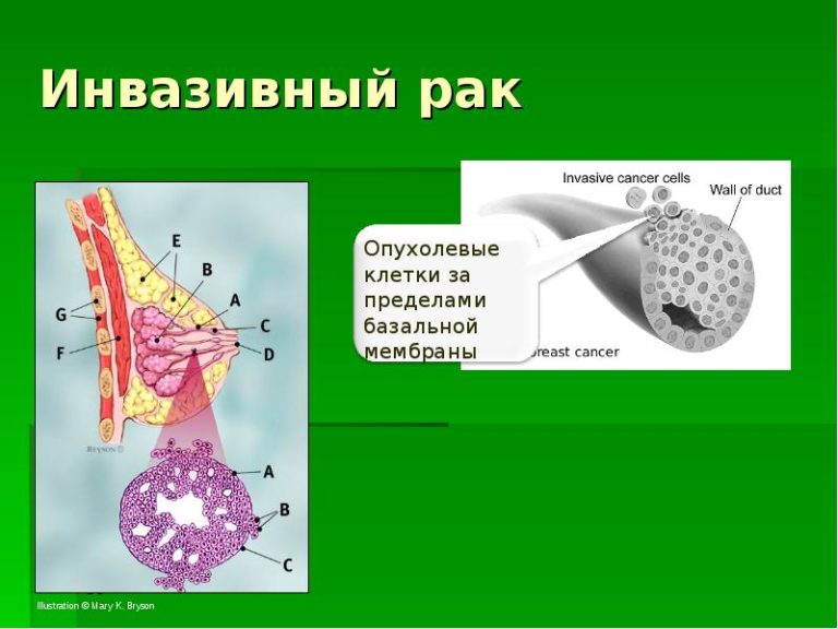 Базальноклеточная карцинома фото и описание