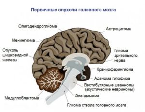 Глиома ствола головного мозга у детей фото