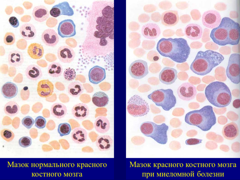 Схемы лечения множественной миеломы