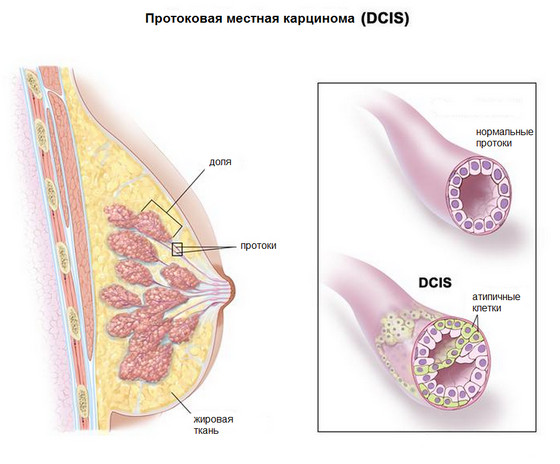 Протоковый рак молочной железы: особенности формы заболевания