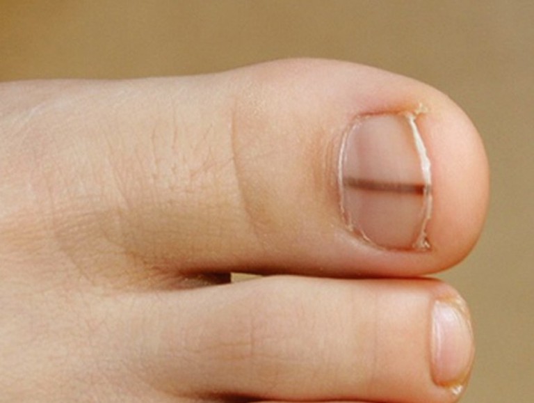 Меланома ногтя: опасные изменения в структуре ногтей