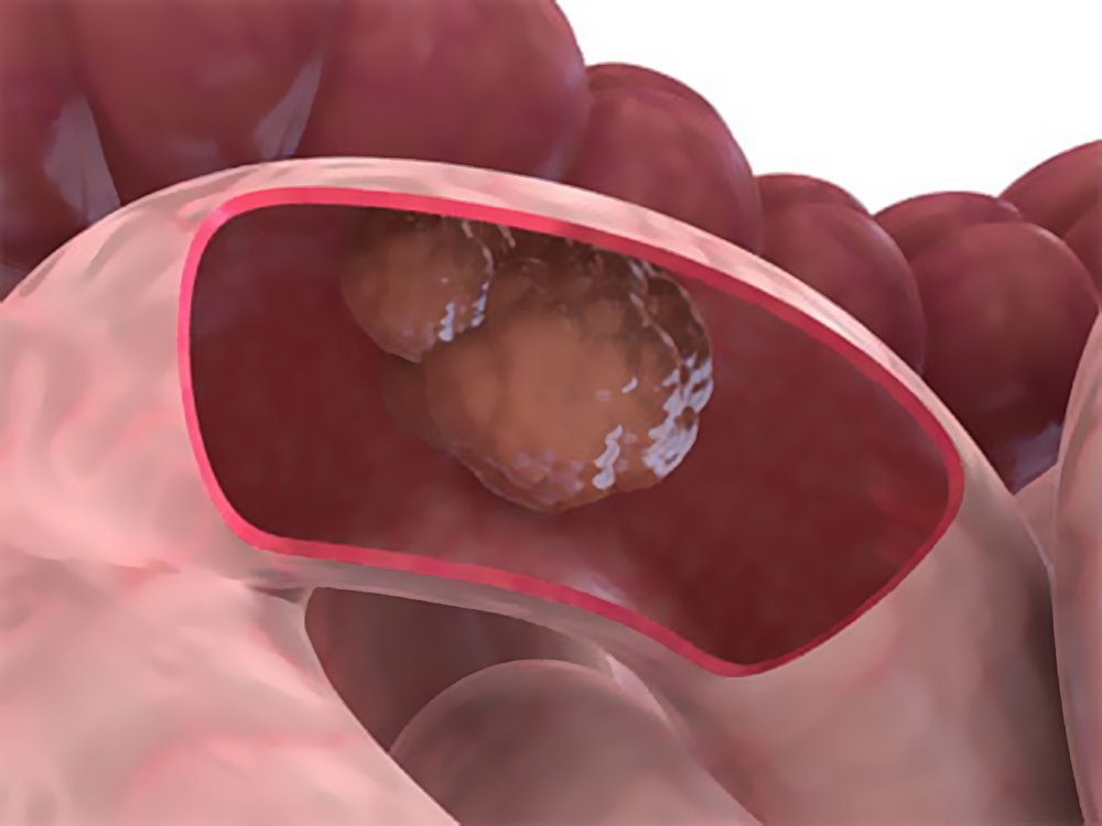 Рак тонкого кишечника: характер проявления и лечение патологии