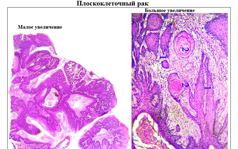 Клиническая картина рака легкого