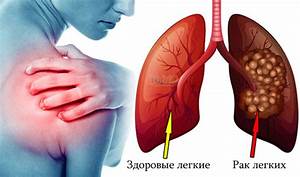 Особенности болей при раке легких, груди, спины и других органов