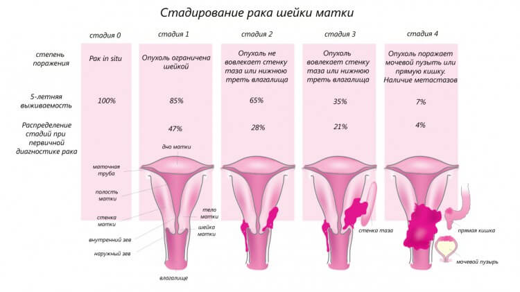 Особенности рака шейки матки 3 стадии: полный обзор