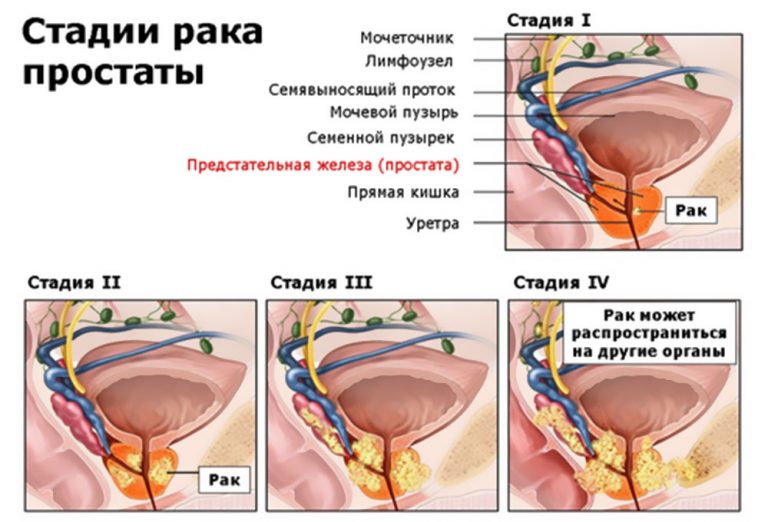 Рак предстательной железы 2 стадии: полный обзор патологии