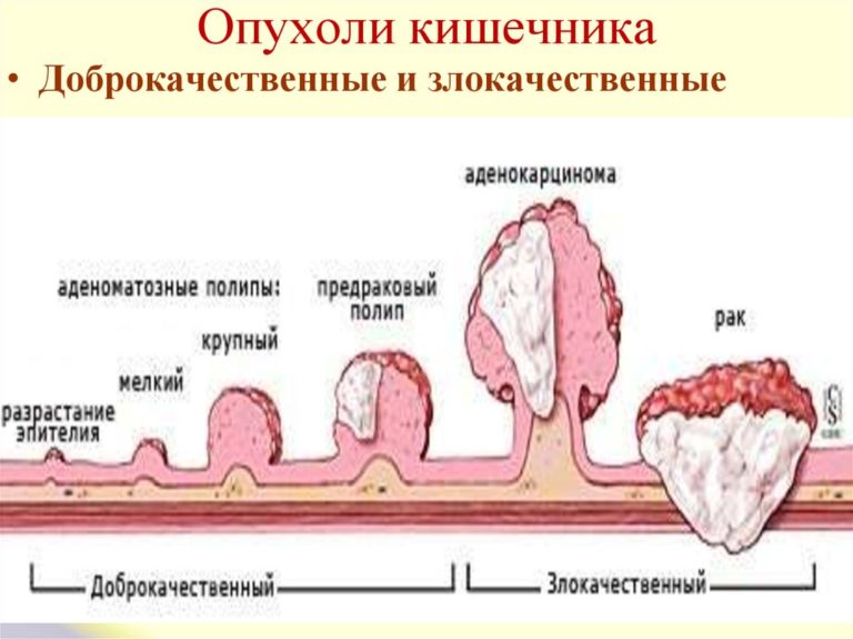 Рак кишечника картинки