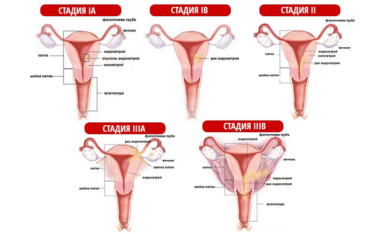 Особенности рака шейки матки 3 стадии: полный обзор