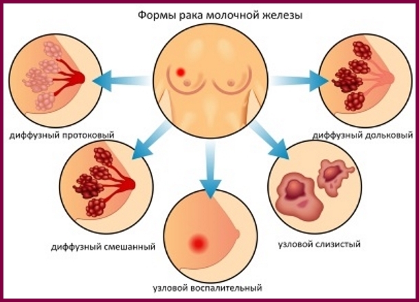 Обзор рака молочной железы в гормонозависимой форме