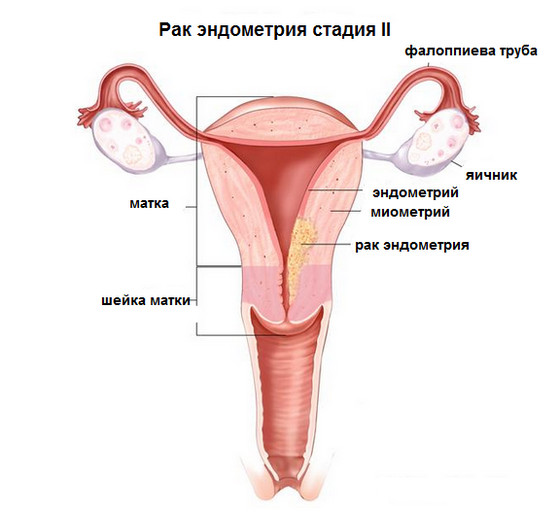 2 стадия онкологии матки и шейки матки: признаки, лечение, профилактика