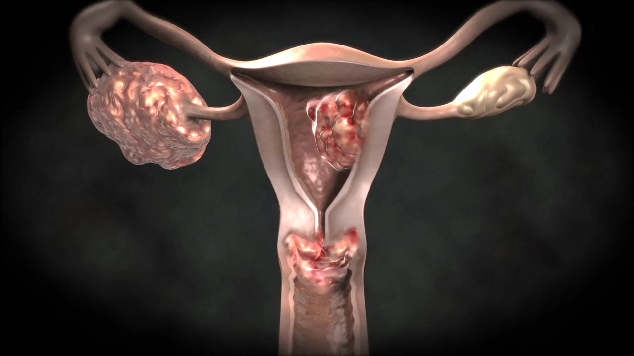 рак матки из за спермы фото 116