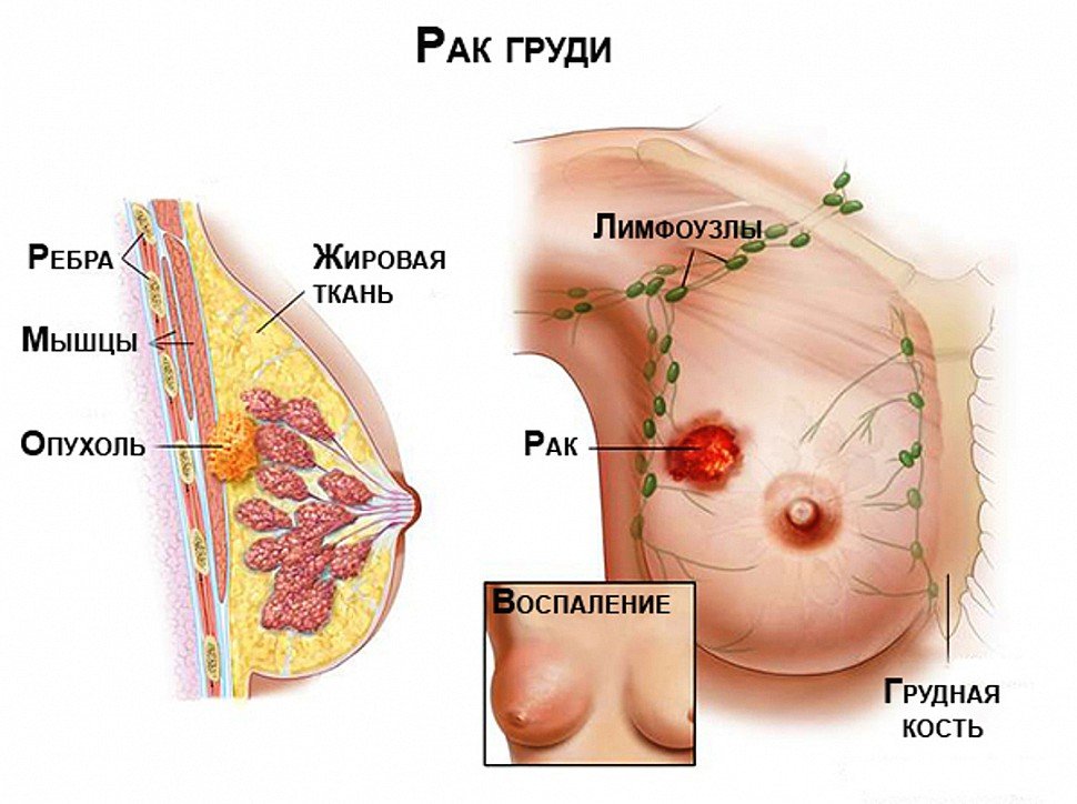 Код рака молочной железы по МКБ 10: C50, подвиды внутри