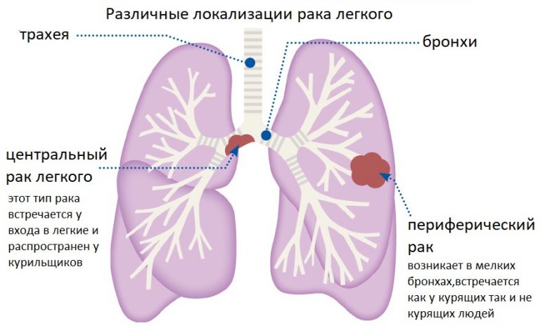 Лечение рака картинки