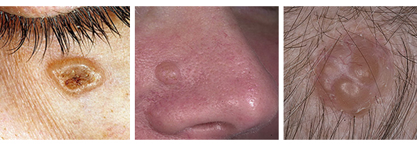 Базалиома кожи лица и на носу: лечение, прогноз, народные средства
