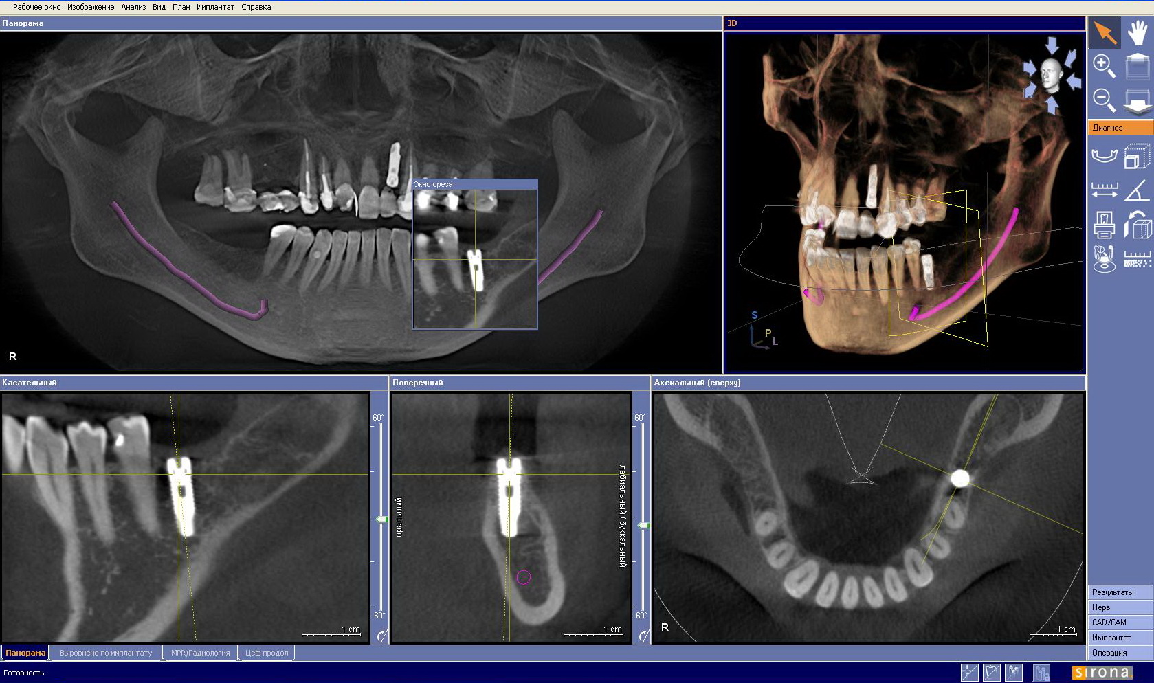 Кт нижней челюсти цена в ульяновске. Кт 3d верхней и нижней челюсти. Компьютерная томография челюсти снимок. Компьютерная томография зубов: 3d диагностика челюсти. Кт имплант верхняя челюсть.