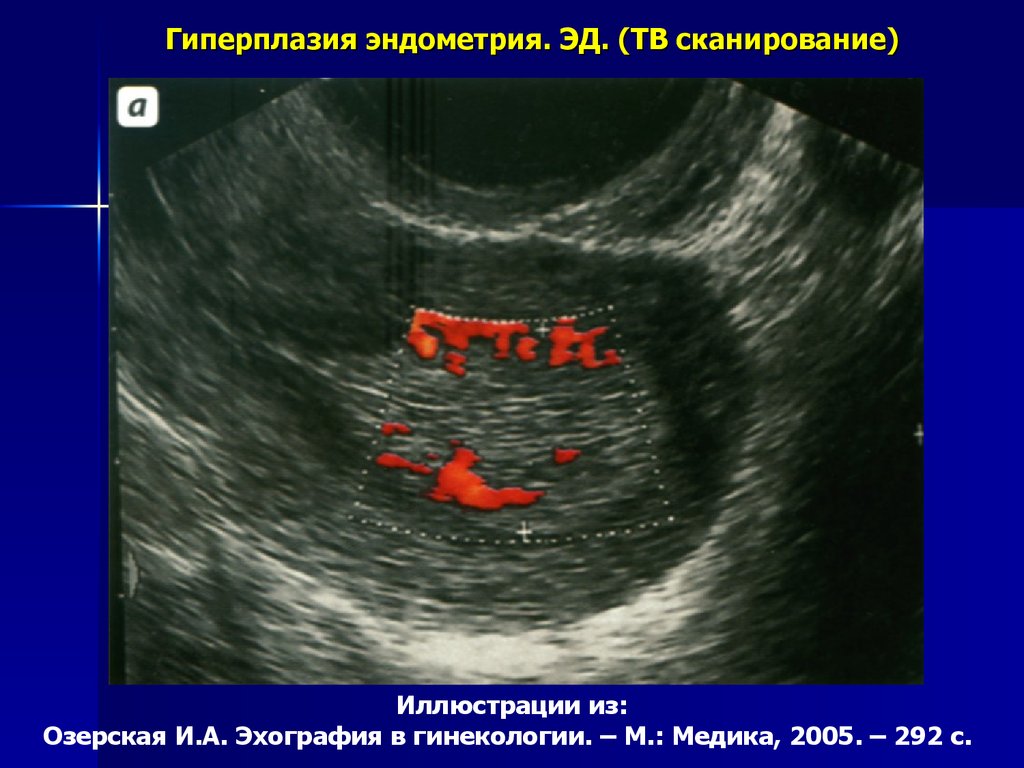 Эндометрия стенок матки. Гиперплазия эндометрия МФЯ. Атипическая гиперплазия эндометрия терапия. Эхограмма гиперплазии эндометрия. Очаговая гиперплазия эндометрия на УЗИ.